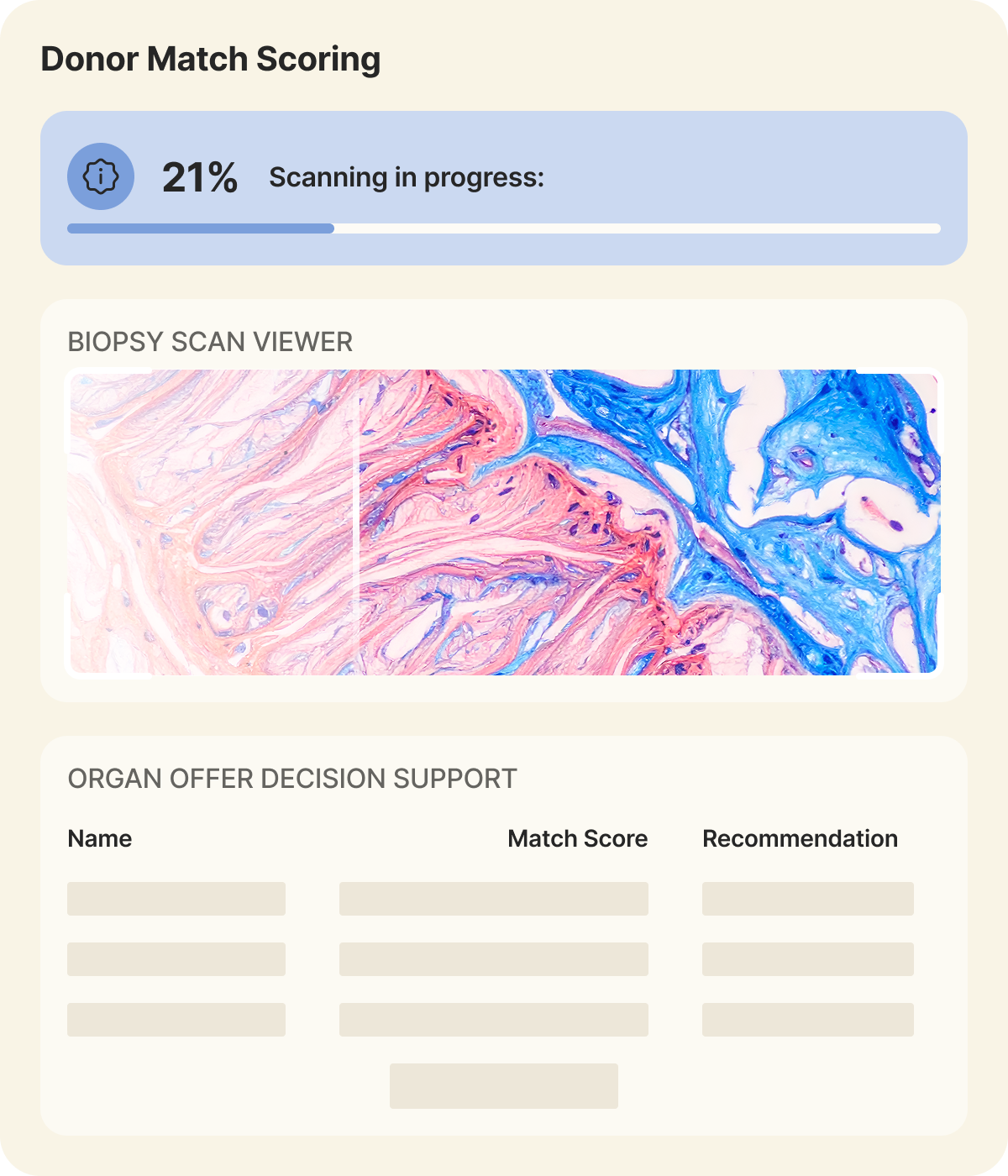 Real-time organ offer evaluator interface showing donor details, match score, ischemia time, and AI recommendation